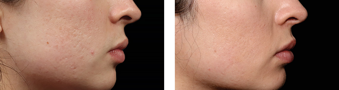 EXION-before-after4