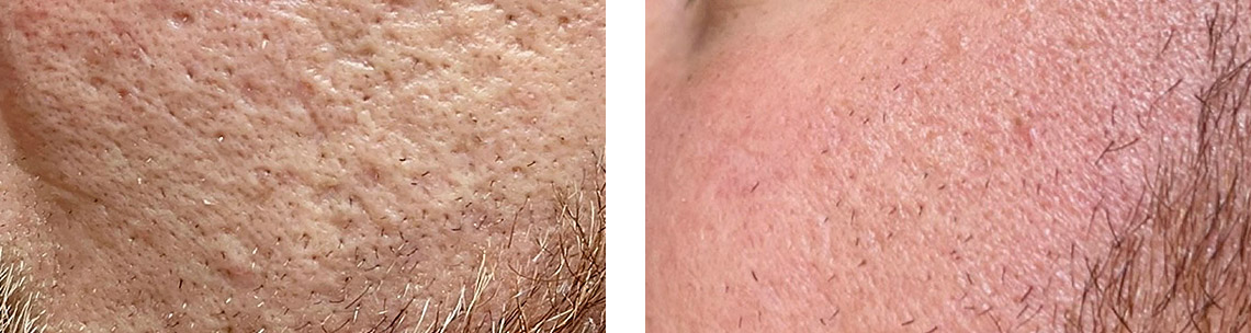 EXION-before-after5