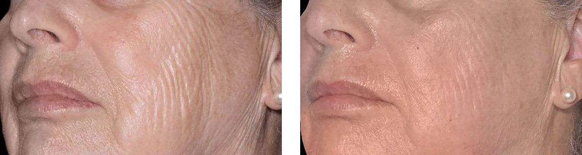 EXION-before-after6