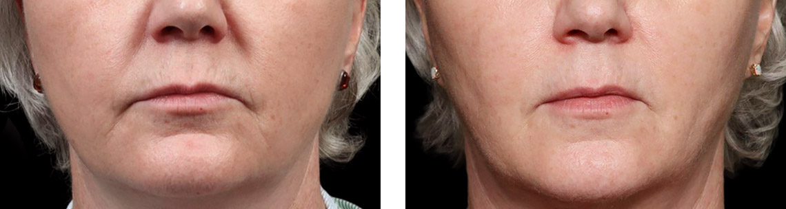 EXION-before-after7
