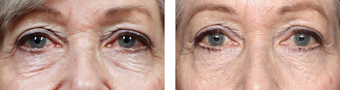 EXION-before-after8